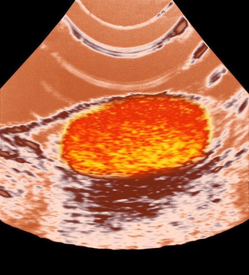 ultrazvukové vyšetrenie semenníkov