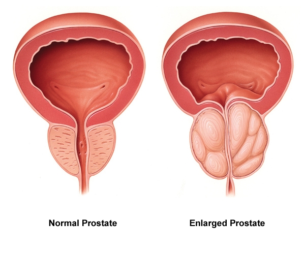 normálna a zväčšená prostata